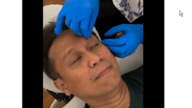 Menteri Kesehatan Budi Gunadi Sadikin mendapat perawatan di RSCM, untuk menjahit luka di pelipis kanan 2.5, cm akibat terpeleset di kamar mandi, Minggu 2 Februari 2025. Tangkap Layar Video Instagram@bgsadikin