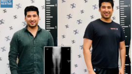 Alfonso Flores adalah seorang mahasiswa kedokteran di Texas, Amerika Serikat. Dia rela merogoh koceknya Rp 1 miliar untuk menambah tinggi badannya 5 cm, dari 180 cm menjadi 185 cm. Operasi dilaporkan berjalan baik. Instagram@bagikertas.id