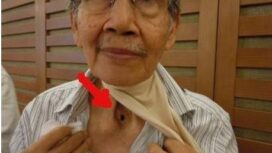 Leher dilubangi akibat rokok (IST)