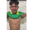 Beginilah bekas memar yang masih terdapat di dada Firman Nugraha, pemain Perseta Tulungagung, yang mendapat tendangan brutal dari pemain Putra Jaya Pasuruan, Muhammad Hilmi, yang saat ini mendapat saksi dipecat dari klubnya. Foto: Instagram@emosijiwakucom