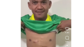 Beginilah bekas memar yang masih terdapat di dada Firman Nugraha, pemain Perseta Tulungagung, yang mendapat tendangan brutal dari pemain Putra Jaya Pasuruan, Muhammad Hilmi, yang saat ini mendapat saksi dipecat dari klubnya. Foto: Instagram@emosijiwakucom