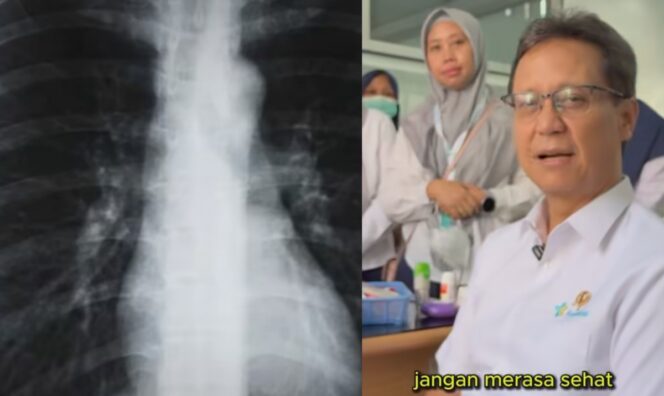 
					Paru-Paru Tampak Normal di Rontgen, Menkes Ingatkan Bahaya yang Tak Terlihat
